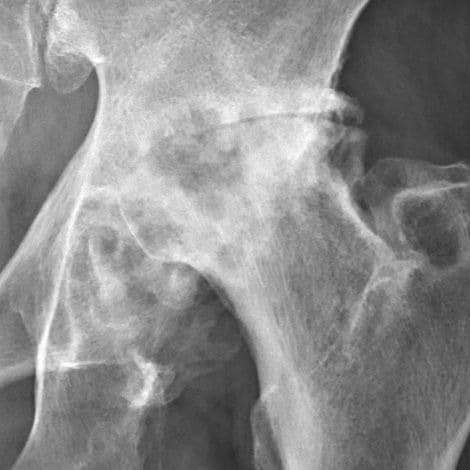 Hip osteoarthritis