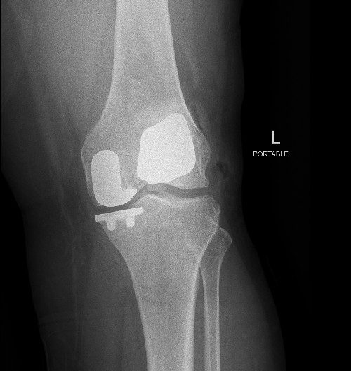 Why replace the whole knee if only part is worn?