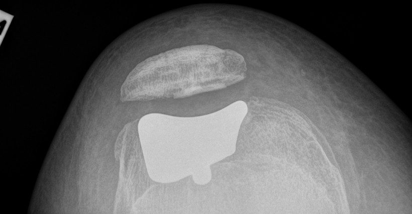 Pain at the front of your knee?