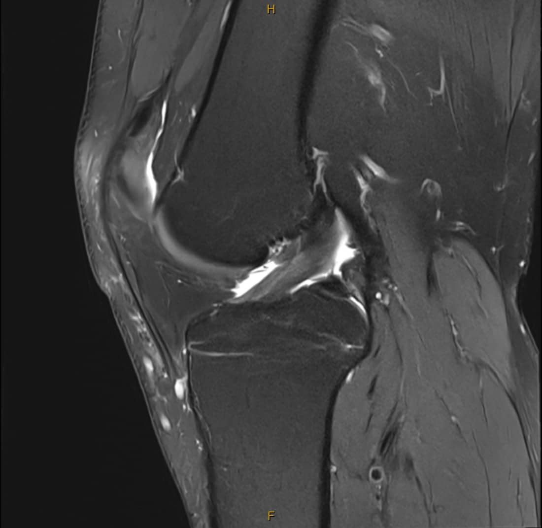 Knee MRI showing an intact, healthy ACL as a continuous band