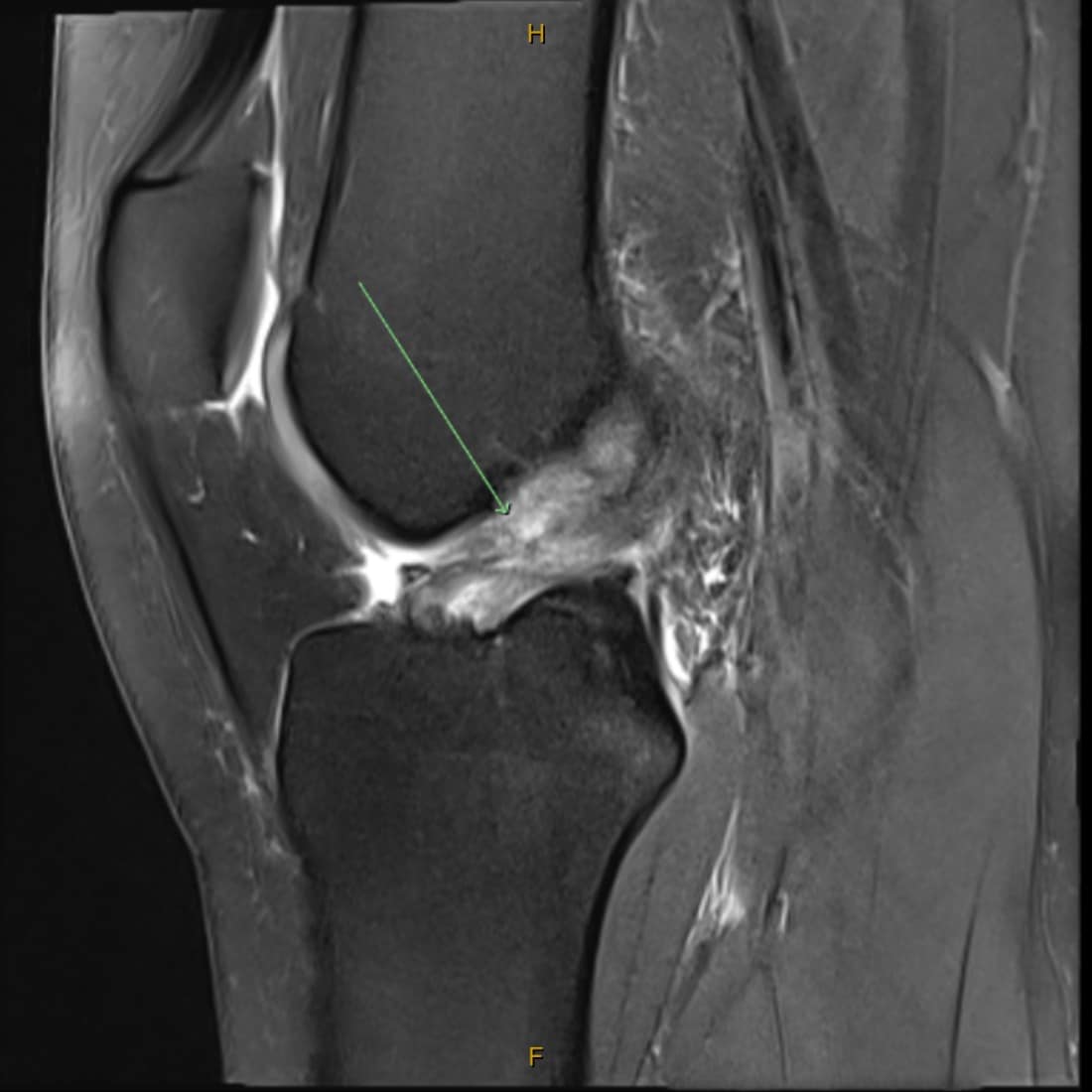 Knee MRI showing a ruptured ACL with a gap and swelling