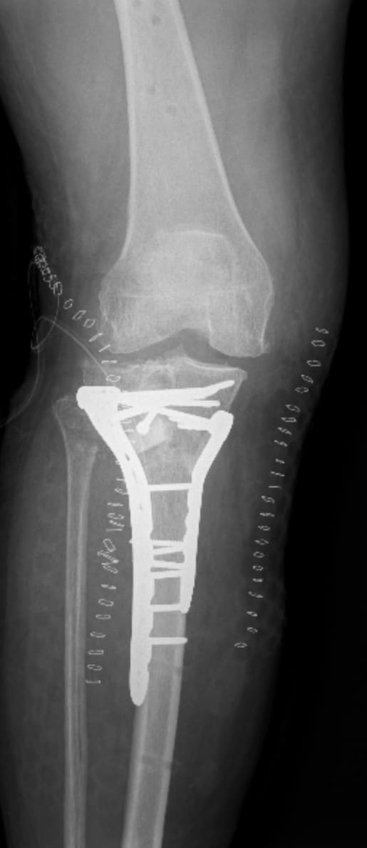 Breaks at the knee