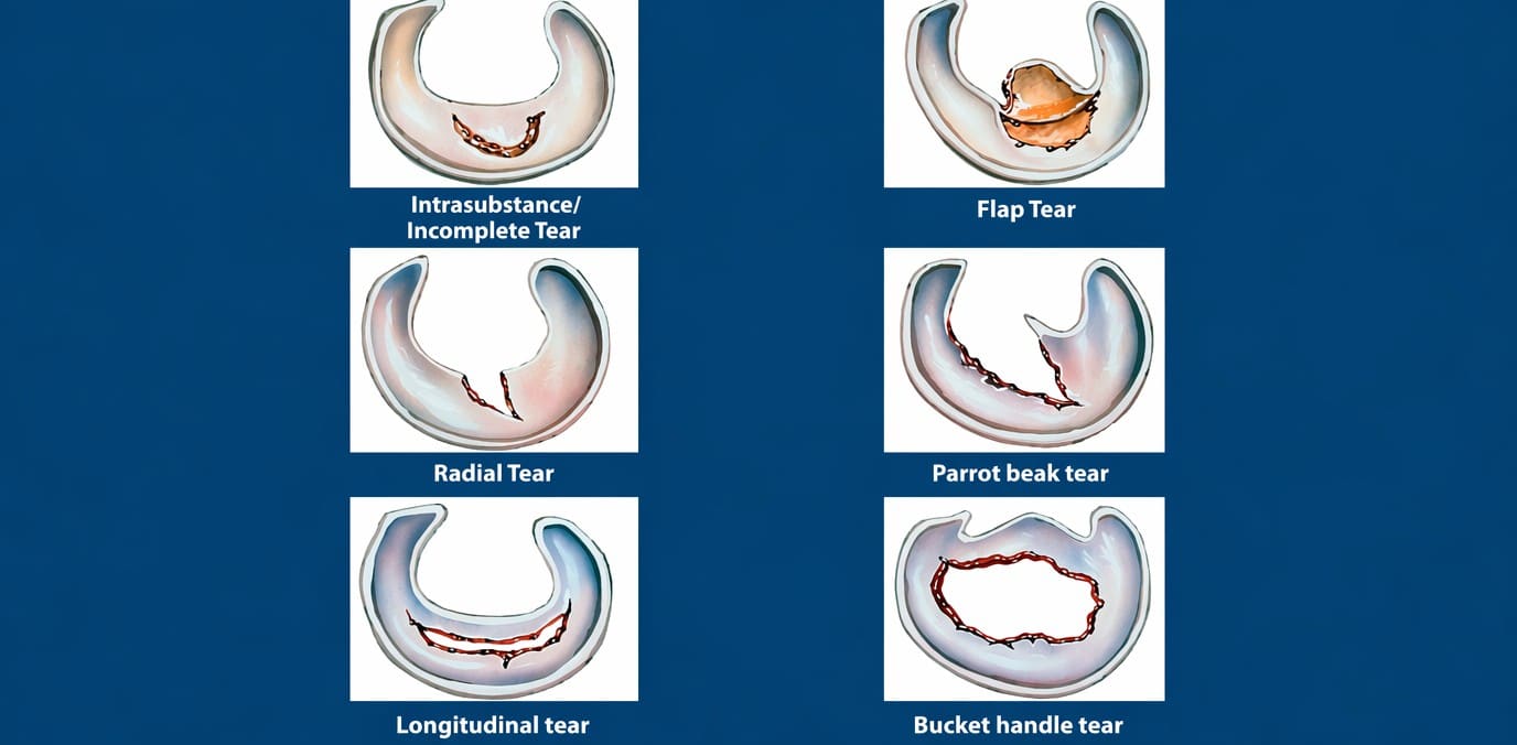 Types of meniscus tears: intrasubstance, radial, longitudinal, flap, parrot-beak and bucket-handle