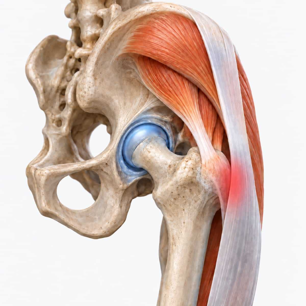 Three-dimensional illustration of the outside of the hip: the gluteal tendons and the iliotibial band passing over the bony point, highlighted red where they rub