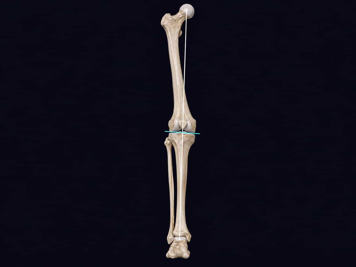 Conceptual leg model showing a hip-to-ankle axis and a separate knee joint-line angle.