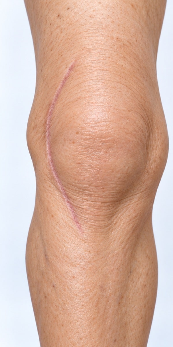 Front of a knee with a healed scar curving to the outer side of the kneecap.