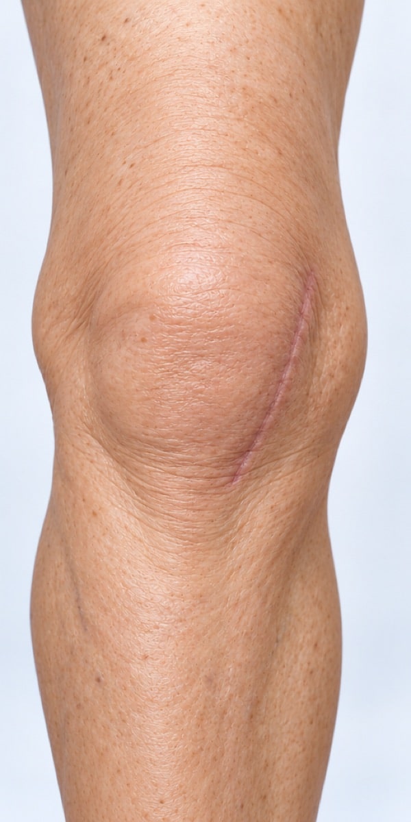 Front of a knee with a healed scar angled to the inner side of the kneecap.